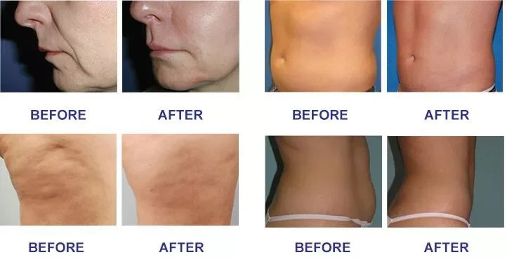 Cellulite Treatment Machine Vacuum Slimming Cellulite Removal Vacuum Legacy Skin Lifting SPA Device 2025