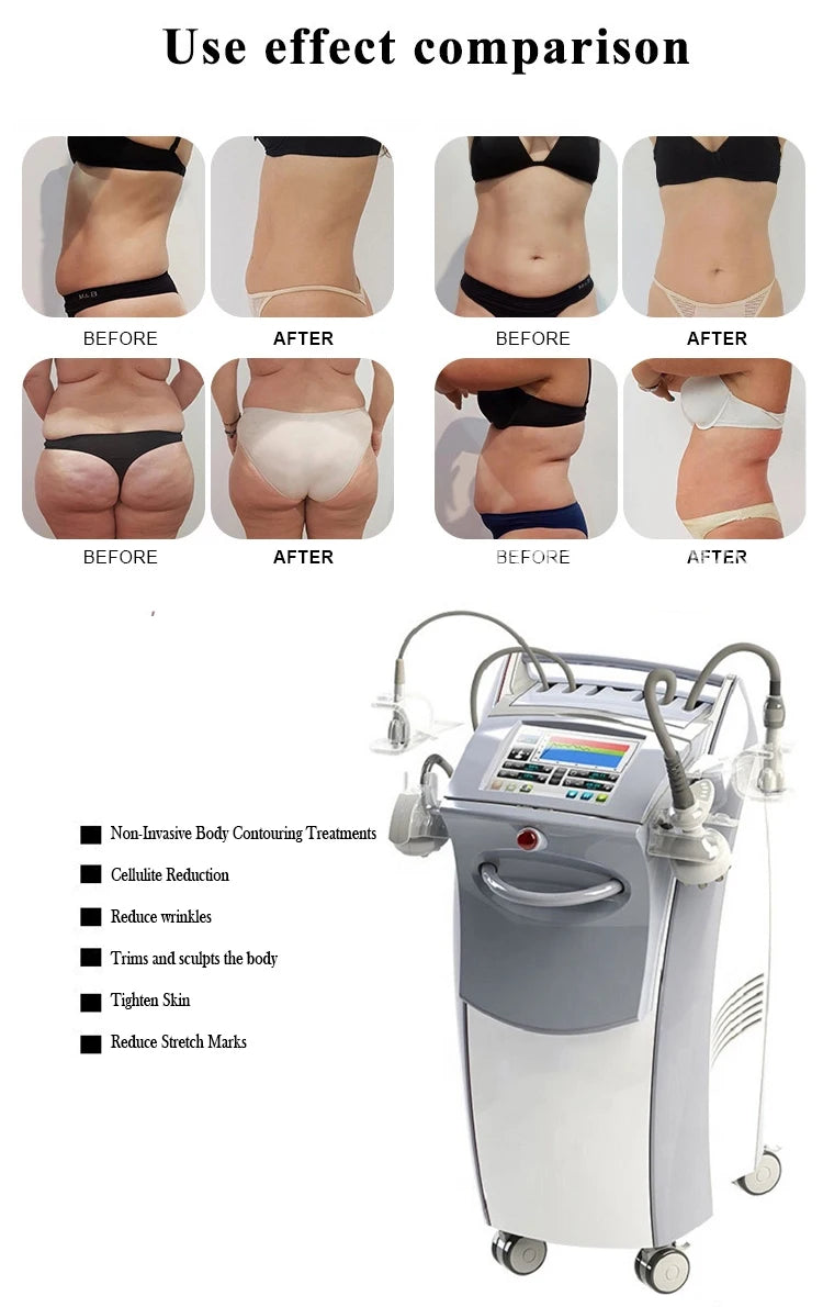 Cellulite Treatment Machine Vacuum Slimming Cellulite Removal Vacuum Legacy Skin Lifting SPA Device 2025